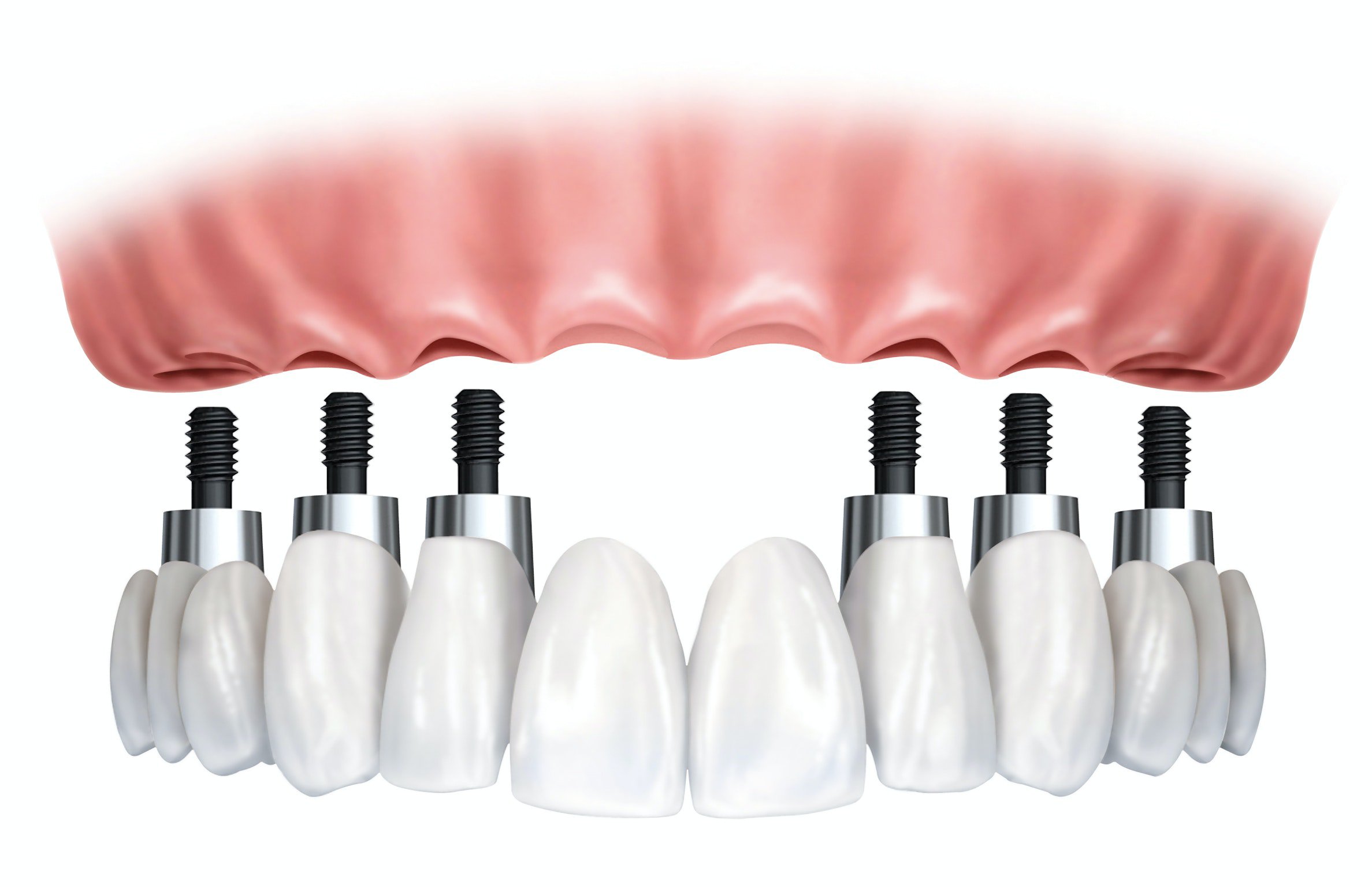 Implant denture