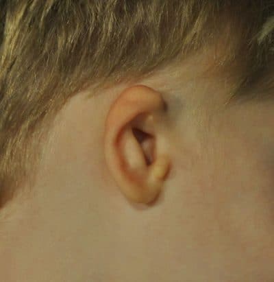 Grade 1 Microtia