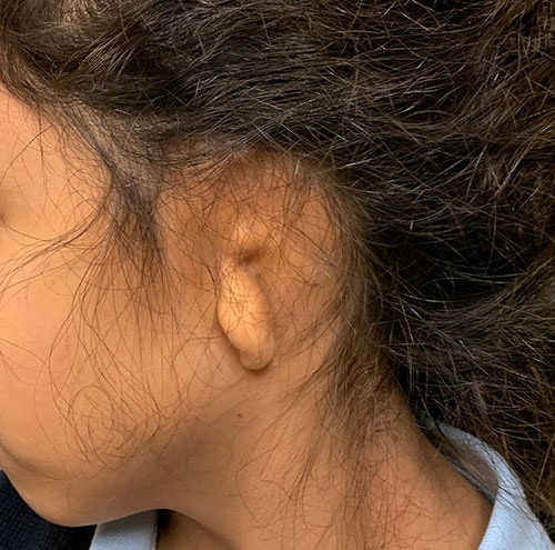 Close Up of Atresia Patient