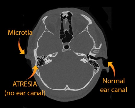 A CT scan of the temporal bones in a patient with microtia and aural atresia