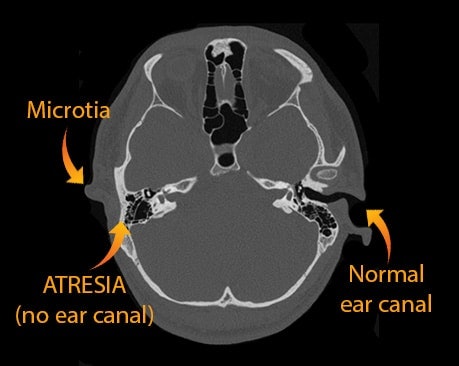A CT scan of the temporal bones in a patient with microtia and aural atresia