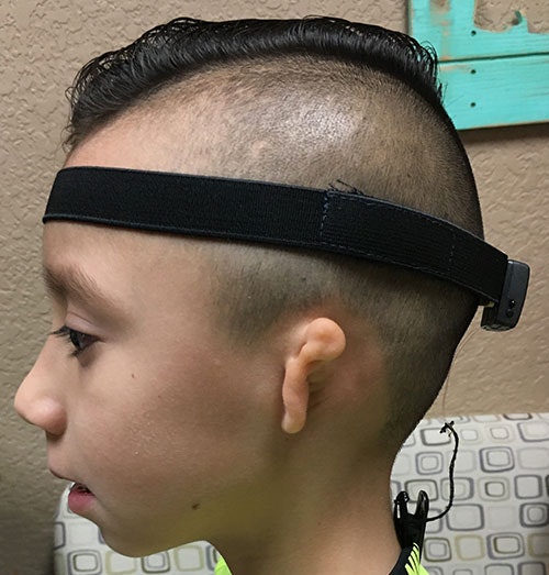 The left ear of a microtia patient with a BAHA hearing aid softband.