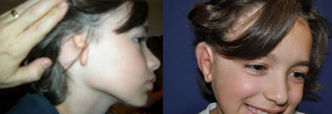 A young boy with microtia before and after his surgical reconstruction