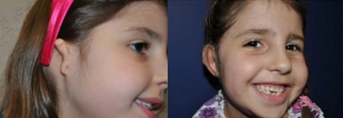 Grade 3 microtia before and after surgery.