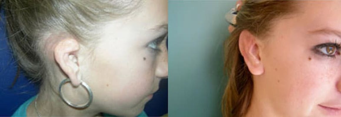 A teenage girl with grade 2 microtia before and after surgery