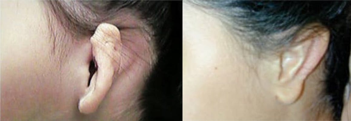 6 year old with left grade 2 microtia before and after surgery.