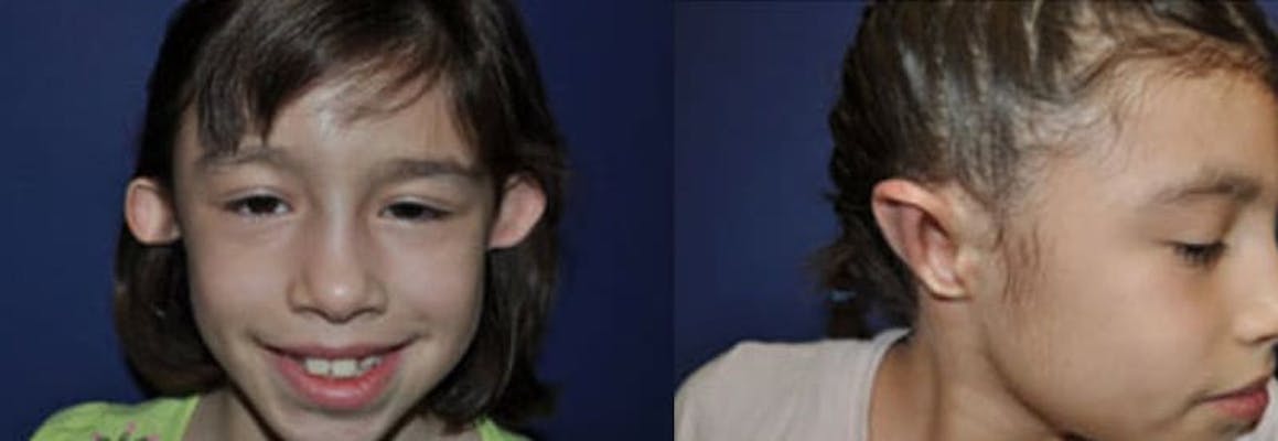 A youn girl with congenital bilateral ear deformity before & after