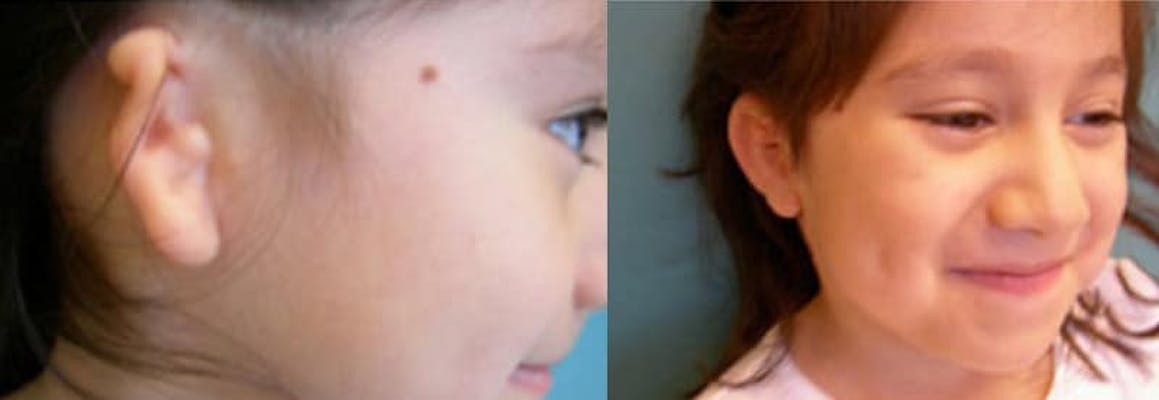 A girl with right-sided grade 3 microtia ear deformity before and after reconstruction