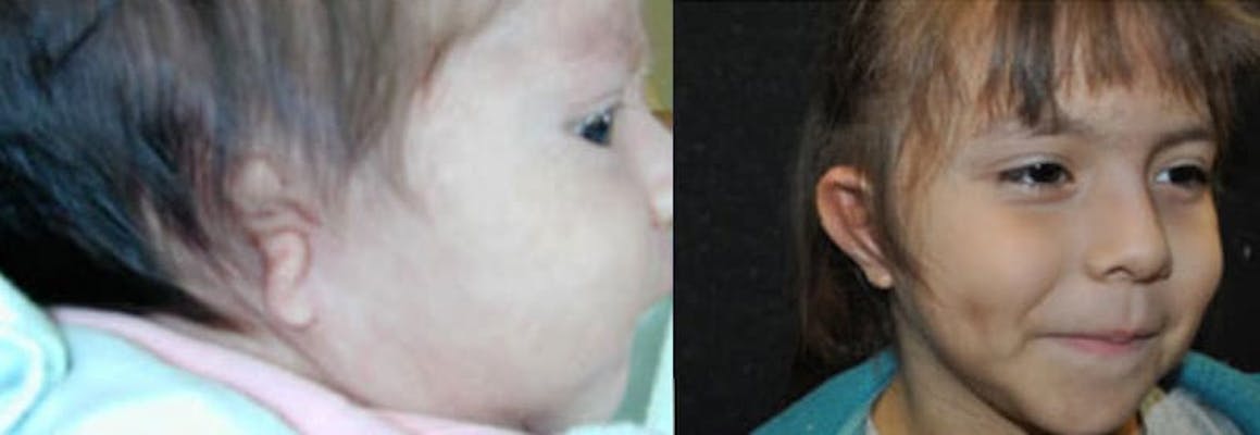 Grade 3 with aural atresia in a girl showing before and after pictures