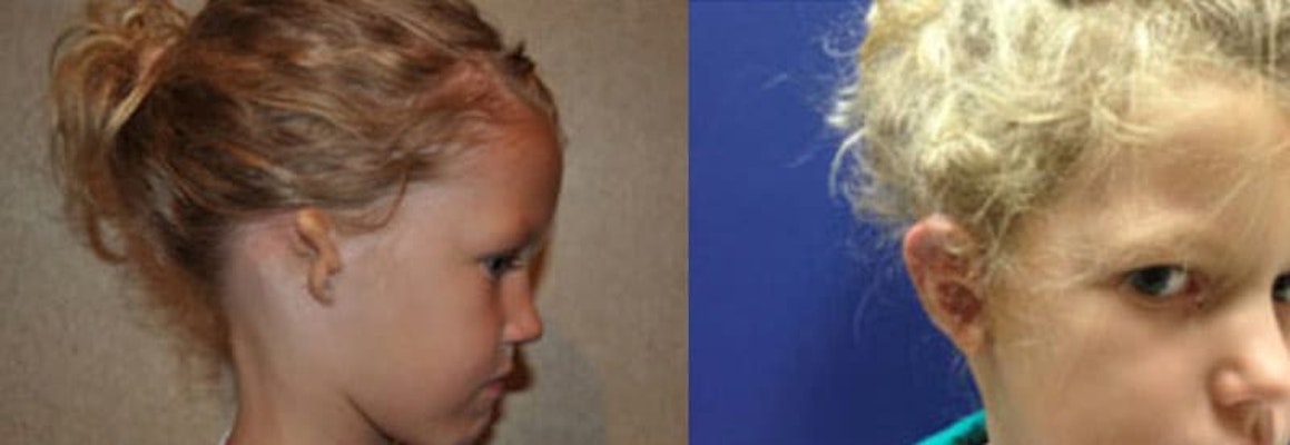 Before and After microtia reconstruction in a young girl with grade 3 microtia
