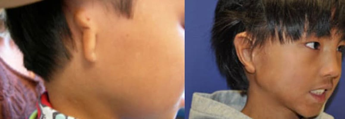 Right grade 3 microtia and atresia before & after reconstruction
