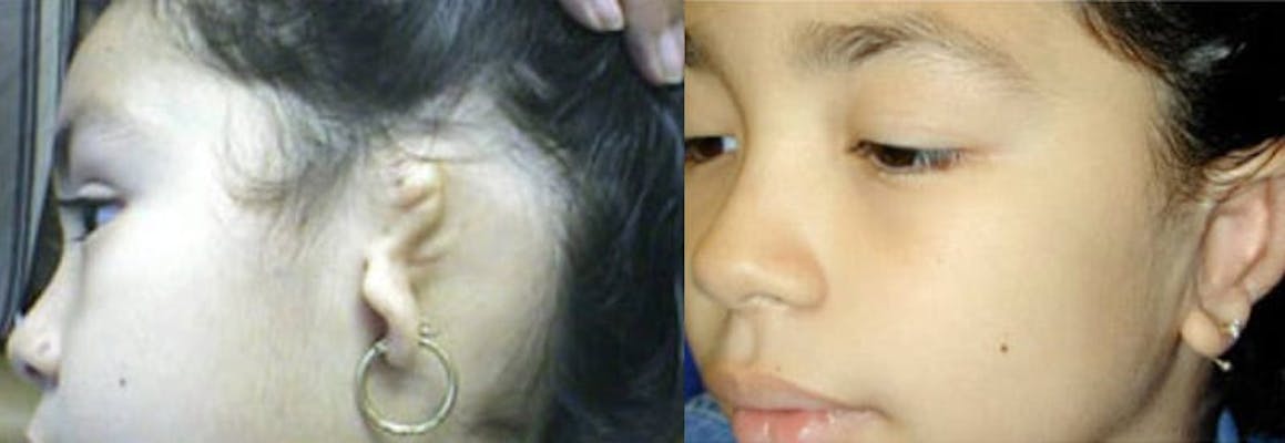 Before and after surgical reconstruction of young girl with grade 3 microtia and aural atresia