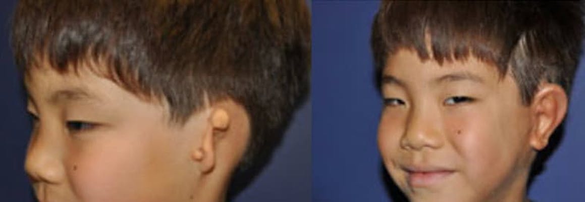 8 year old boy with left grade 3 microtia before & after surgery