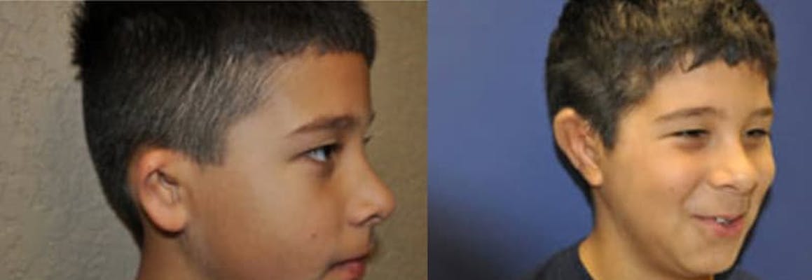 7 year old boy with right microtia before and after microtia surgery