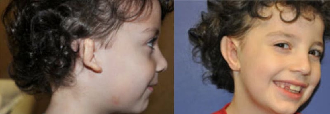 6 year old boy with right microtia before and after reconstruction