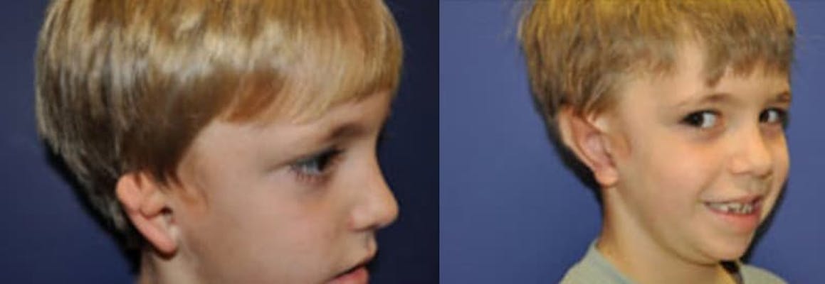 A young boy with right grade 2 microtia before and after surgical reconstruction