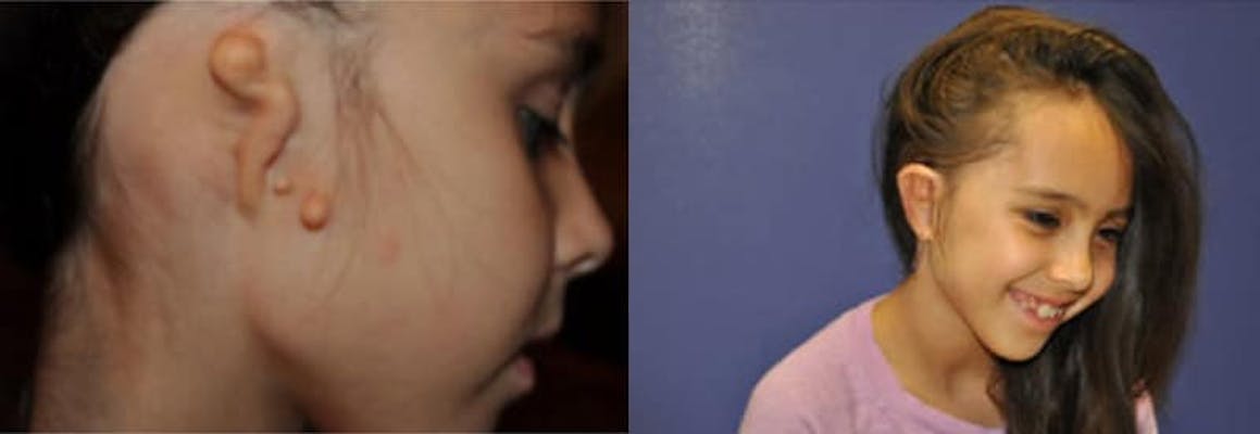Young girl with a grade 3 microtia before and after reconstruction