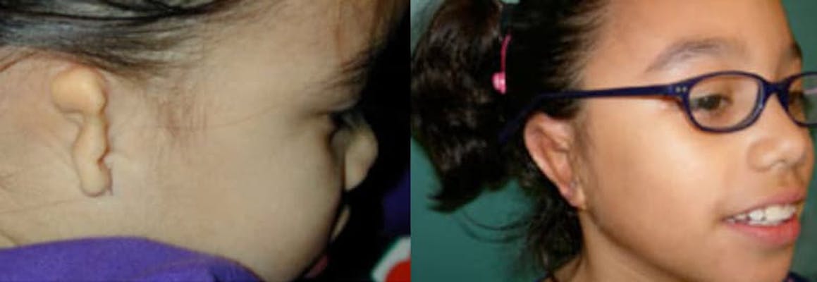 A girl with grade 3 microtia wearing glasses after ear surgery