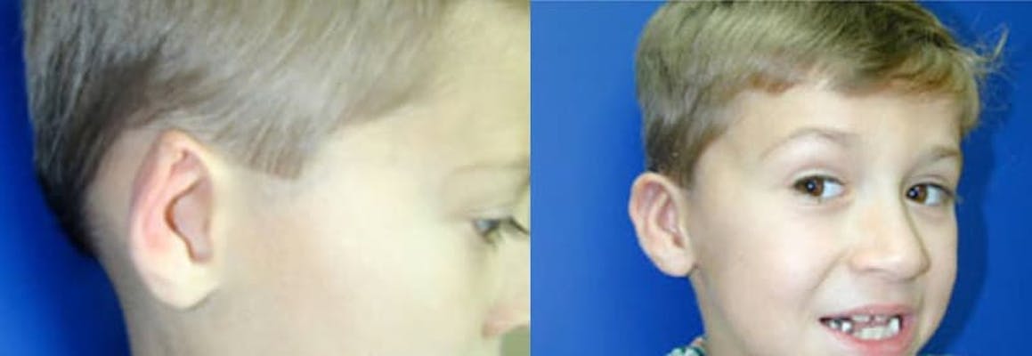 5 year old boy with right ear deformity before and after surgery