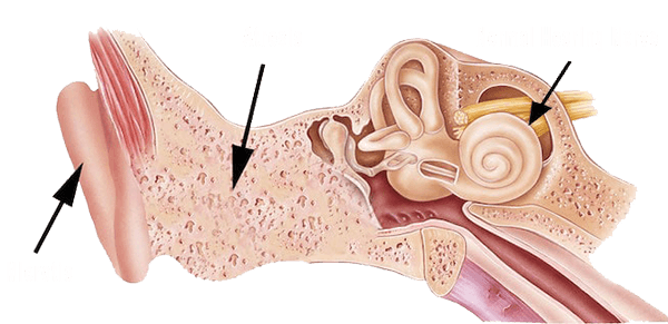 An anatomy drawing of a patient with microtia and aural atresia.