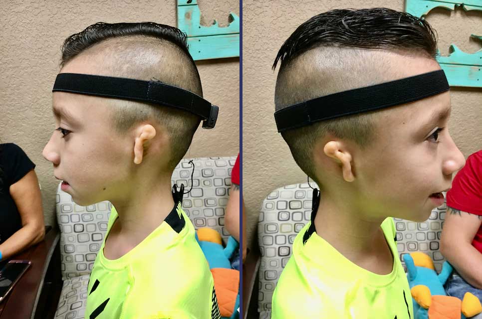 A boy with bilateral grade 3 microtia and atresia wearing a BAHA hearing aid softband
