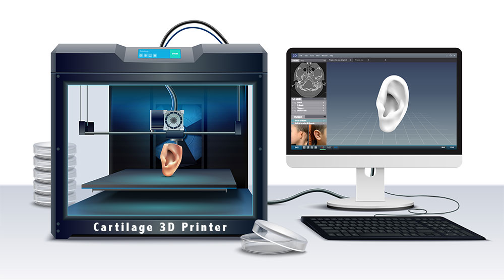 3D Printer of an ear with microtia