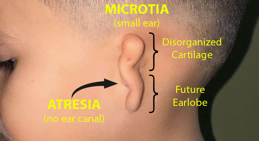 Child with Microtia Ear Deformity and Atresia Showing Anatomic Structures