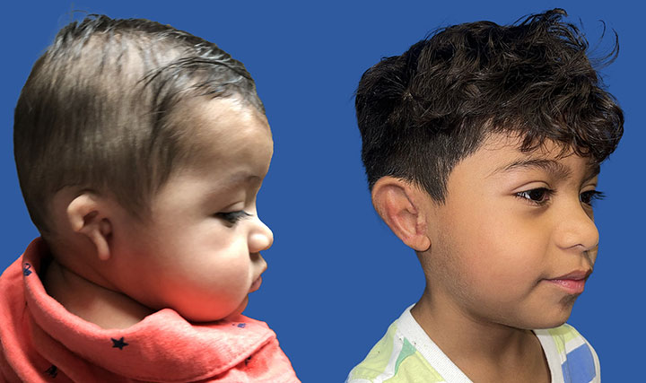 Microtia Before & After pictures of a boy after microtia surgery