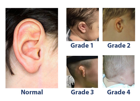 Comparison of ear development: Normal ear versus Microtia Grades 1 to 4, including anotia