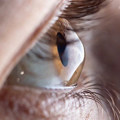 Keratoconus