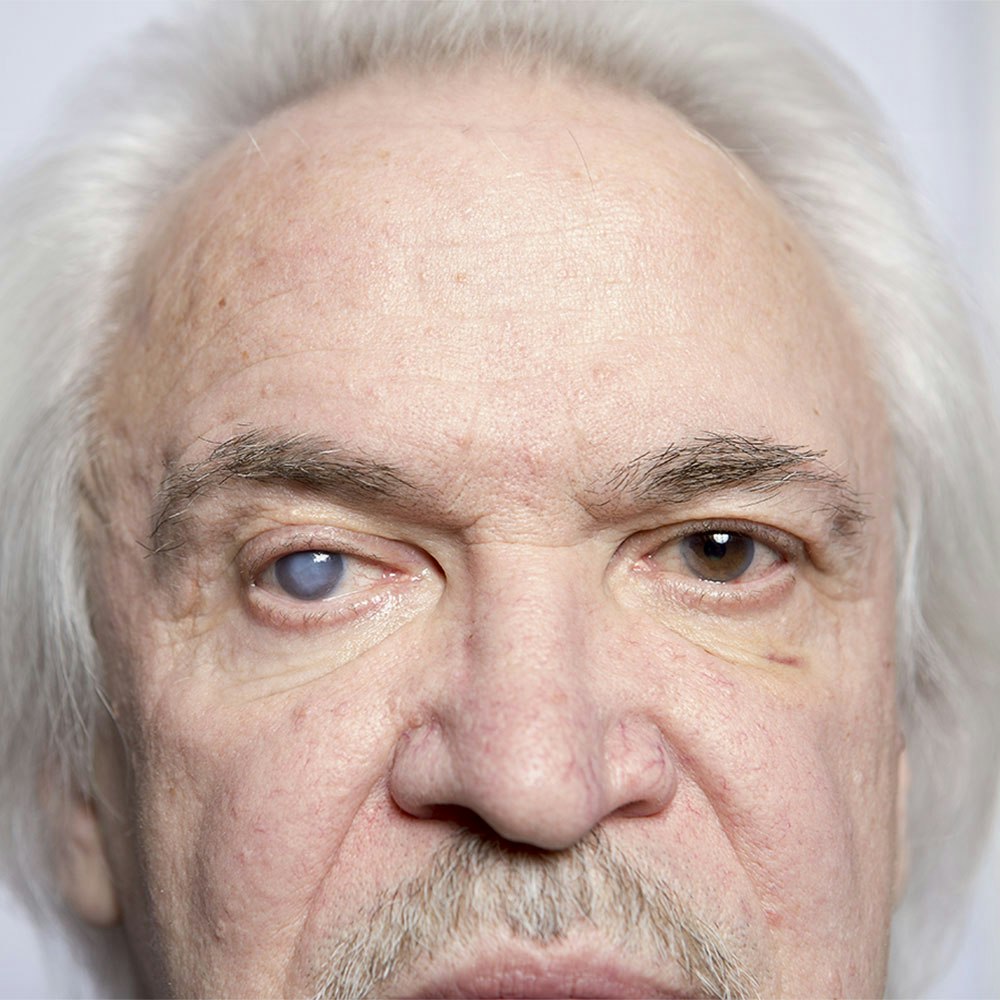 close up of a cataract and normal eye