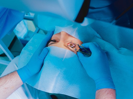 LASIK procedure