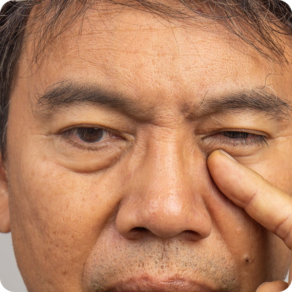 Man pointing to inside corner of his eye