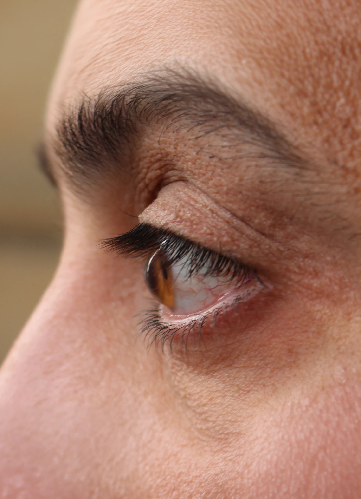 Close up of a bulging cornea