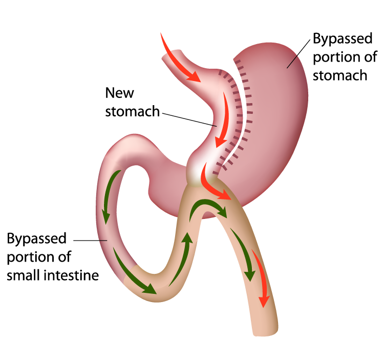 Mini gastric bypass diagram