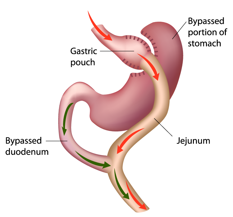 Gastric bypass diagram