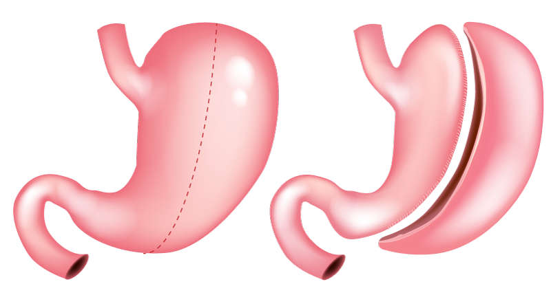 Mini gastric sleeve diagram