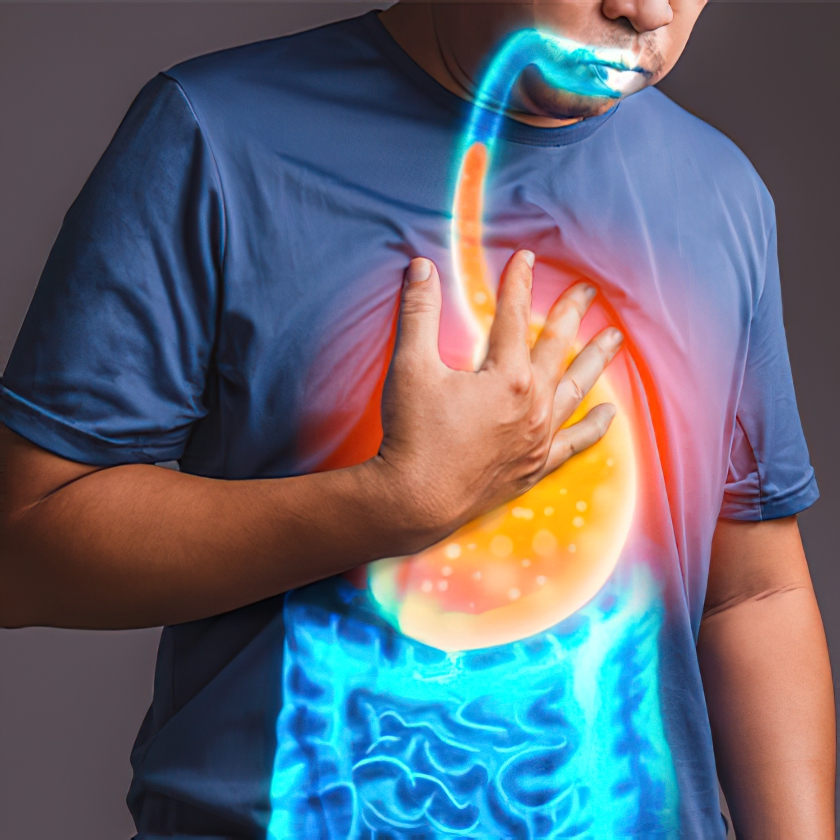 Illustration of GERD