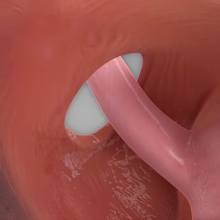 3d image render of a wide opening around the stomach (hiatal hernia)