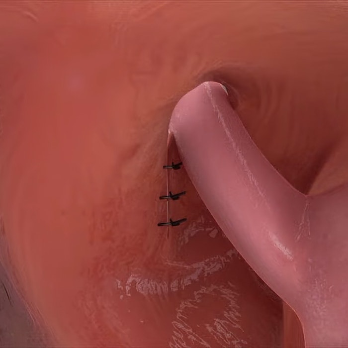 3D image render of repaired hernia opening