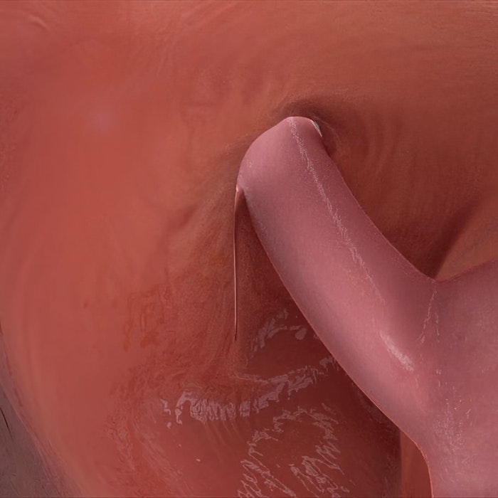 3d render image of repaired hiatal wall
