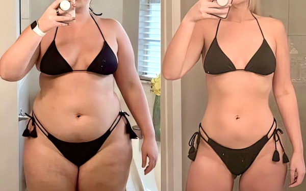 before and after SILS procedure