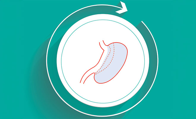 Illustration of revision surgery