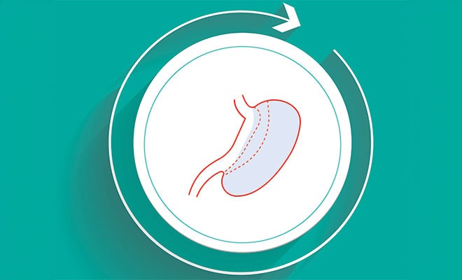 Illustration of revision surgery