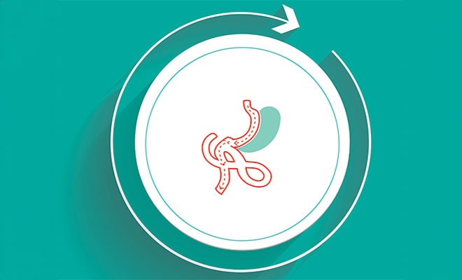 Illustration of duodenal switch surgery