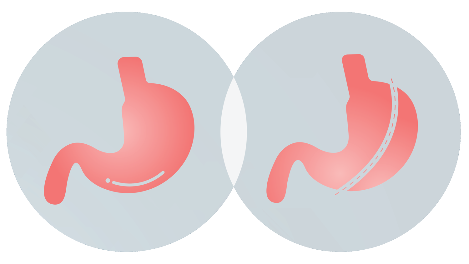 Mini gastric sleeve diagram