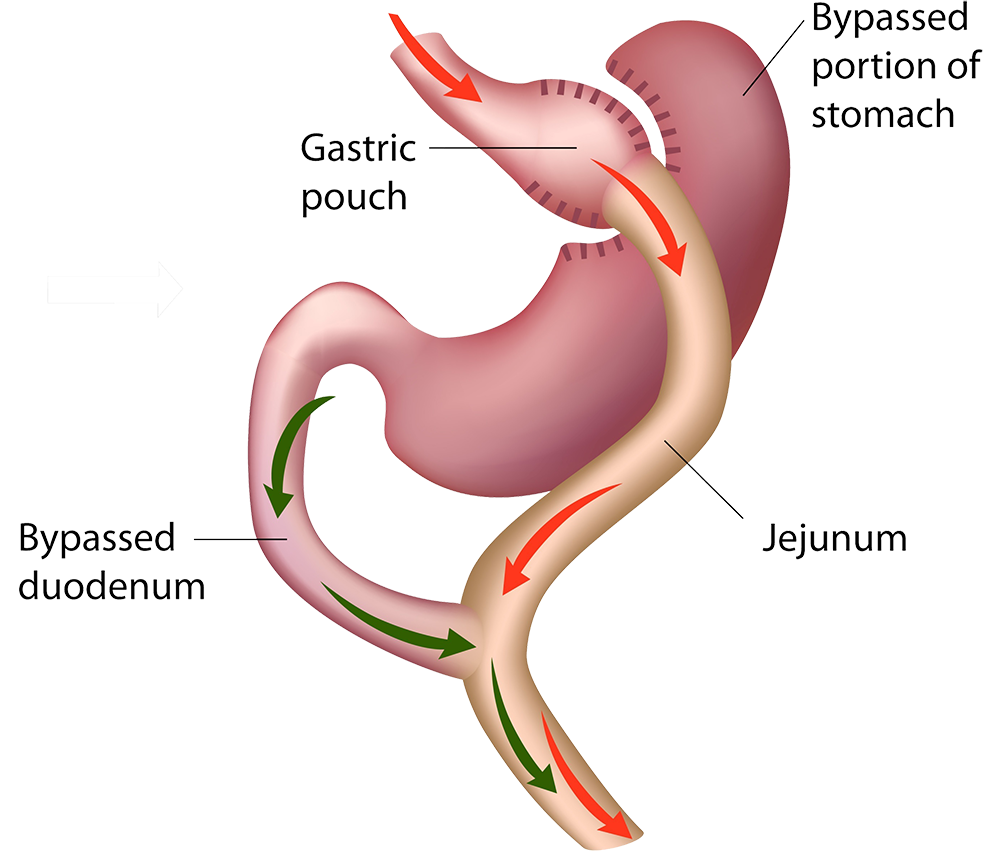 Traditional gastric bypass surgery illustration