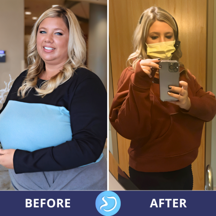 Before and After Photos - Gastric Sleeve Surgery in Mexico
