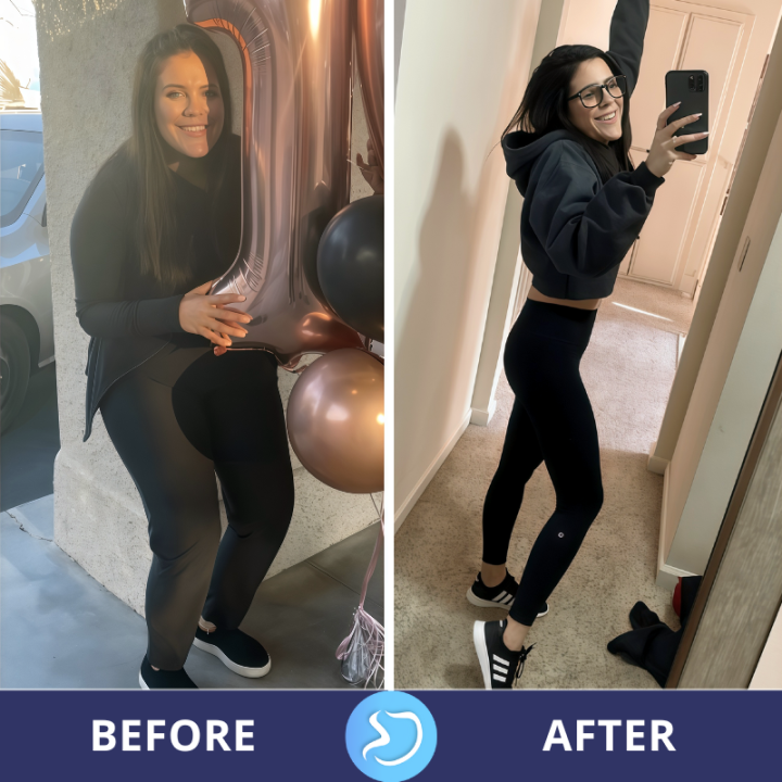 Before and After Photos - Gastric Sleeve Weight Loss Surgery Mexico