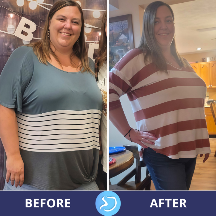 Before and After Photos - Gastric Sleeve Mexico